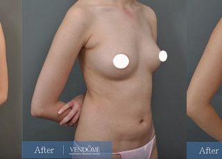 療程效果因人而異，上圖為B罩杯女性在做完自體脂肪隆乳之後​手術後十一個月、手術後一年七個月成效